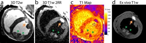 Native Contrast Cardiovascular Magnetic Resonance Cmr Of