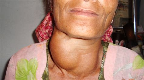 Swollen Thyroid Gland On One Side Of Neck Collections Edison Health