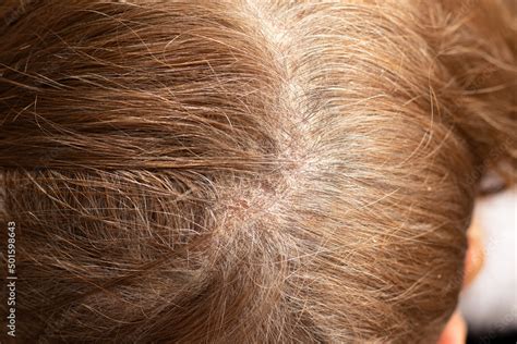 Seborrhea Dermatitis Condition On Female S Scalp A Close Up Of An Irritated Itchy Scalp With
