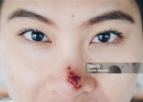 Close Up Of The Herpes Simplex On Asian Woman Nose Stock Photo