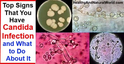 Top Signs That You Have Candida Infection And What To Do About It
