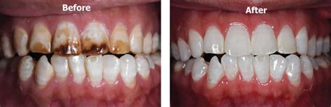 Dental Fluorosis Causes Prevention Symptoms And Dental Fluorosis Treatment
