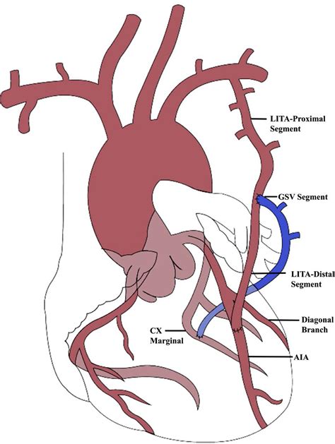 Coronary circulation is the circulation of blood in the blood vessels that supply the heart muscle (myocardium). Intraoperative Analysis of Flow Dynamics in Arteriovenous Composite Y Grafts