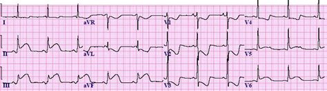 Top 5 Mi Ecg Patterns You Must Know