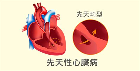 為什麼會得心臟病？常見的心臟病和防治方法 心臟病種類 心臟病預防 大紀元