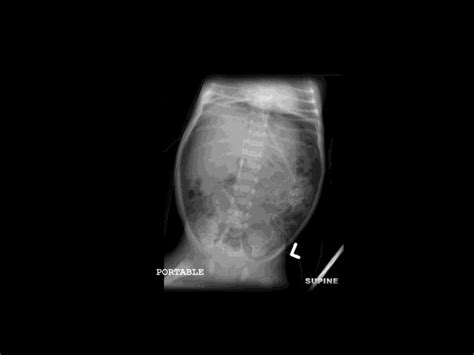 Acute Abdomen Radiology
