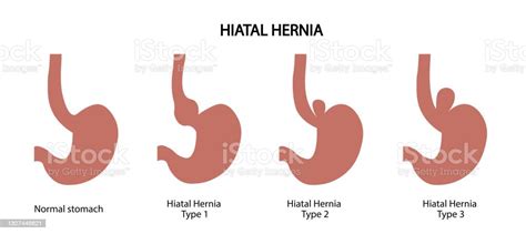 Hiatus Hernia Hiatal Hernia Types Of Hiatal Hernia Illustration Arte