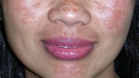 Melasma Causes Symptoms Pictures And Treatment