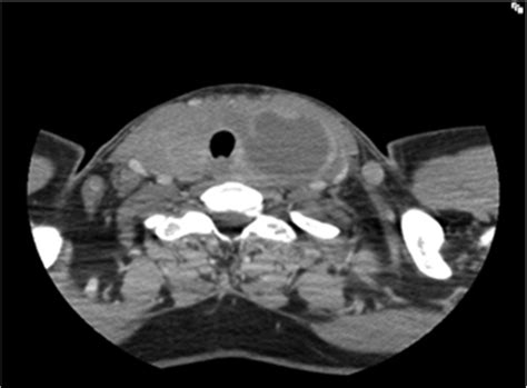Full Text Midline Neck Abscess An Important And Rare Presentation In