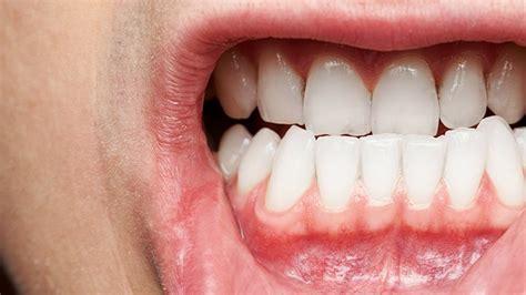 What You Need To Know About Gum Disease Everyday Health