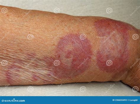 Granuloma Annulare A Rare Skin Disease Stock Image Image Of