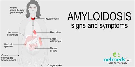 Amyloidosis Causes Symptoms And Treatment