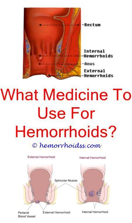 Thrombosed hemorrhoid is external hemorrhoids that have ruptured or they ruptured and developed a clot. Can Hemorrhoids Bleed After Diarrhea? what is a non thrombosed hemorrhoid?.Will Hemorrhoids Go ...