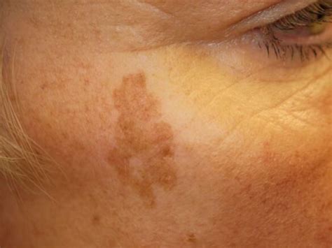 Age Spots Liver Spots Causes On Face Legs Pictures How To Fade