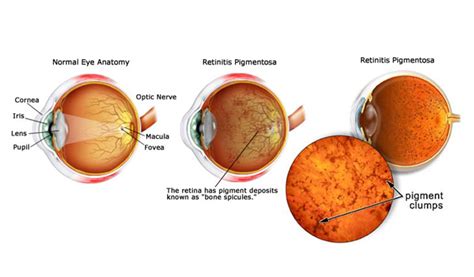 What Is Retinitis Pigmentosa Exploring The Causes Symptoms Irisvision