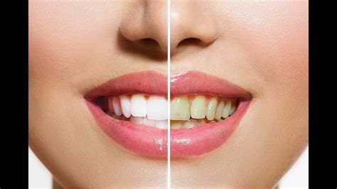 Imagens De Dente Branco Healthbeauty · Productservice · Dentist