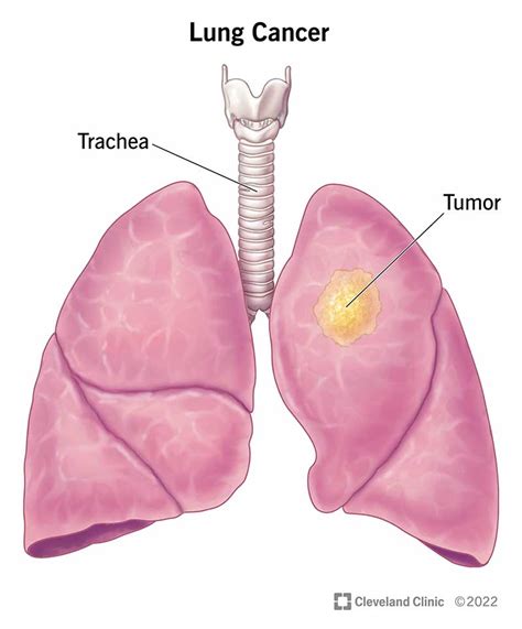 lung cancer types stages symptoms diagnosis and treatment