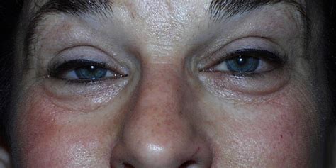 What Is Ptosis American Academy Of Ophthalmology