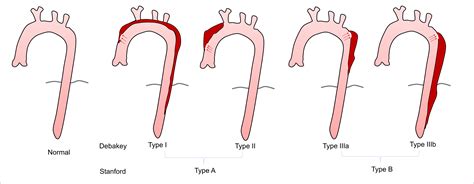 Types Of Aortic Dissection