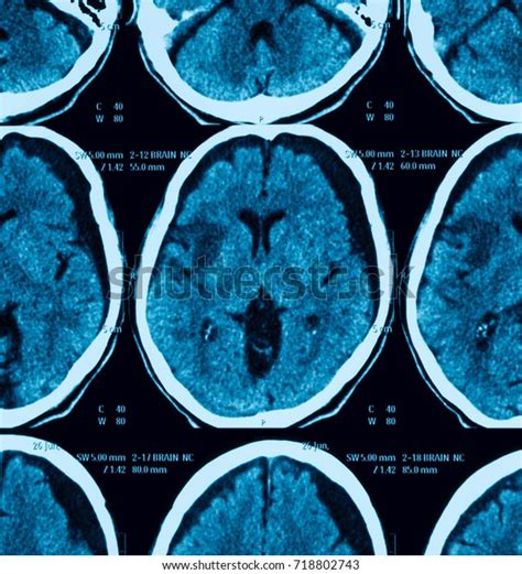 Ct Scan Brain Showing Brain Atrophy 스톡 사진 718802743 Shutterstock