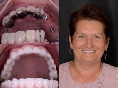 Reabilitare Complex Cu Implanturi Dentare I Coroane Dentare