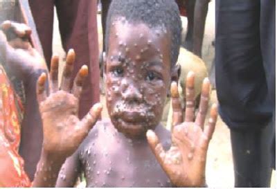 It is called monkeypox because it was first identified in laboratory monkeys. Monkeypox spreads to Rivers and Akwa Ibom (Details) - Kemi ...