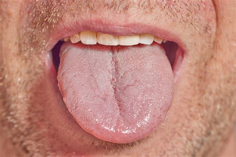 Your Tongue Tells All Study Reveals 94 Accurate Health Diagnosis