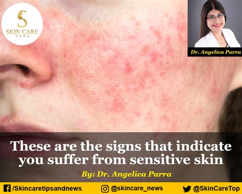 These Are The Signs That Indicate You Suffer From Sensitive Skin