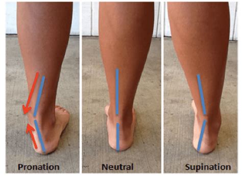 How Pronation Overpronation And Supination Affect You