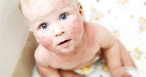Atopic Eczema Research Results In Severe Disease With New Therapy