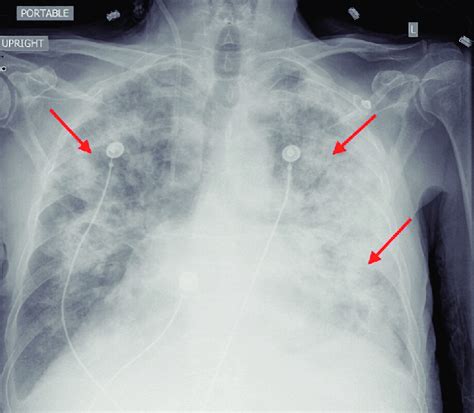 Posteroanterior Chest X Ray Showed Extensive Bilateral Infiltrates Red