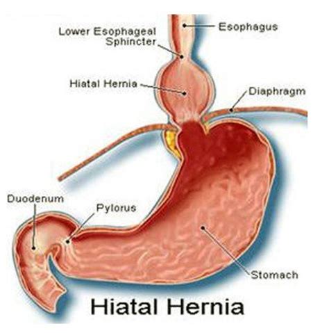 Hiatal Hernia Pictures Symptoms Treatment Recovery Time Surgery