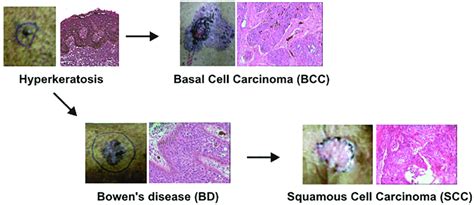 Arsenic Induced Skin Cancer Progression Progression From The