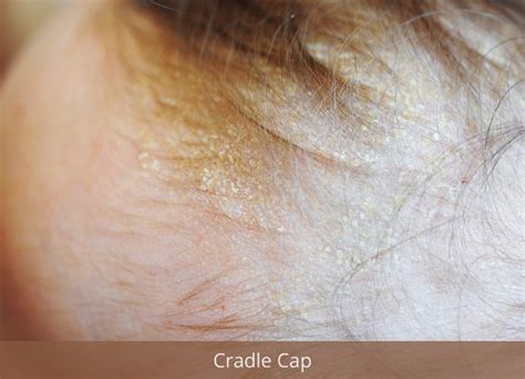 Cradle Cap In Adults