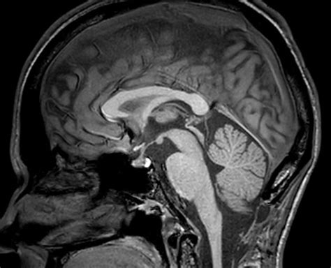 Sagittal Midline Of The Brain Normal Anatomy Radiology Case