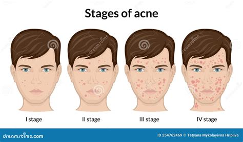 Stages Of Acne Stock Vector Illustration Of Acne Phase 254762469
