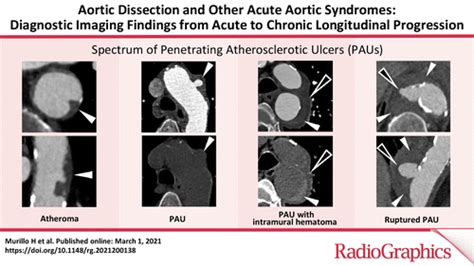 Aortic Dissection X Ray