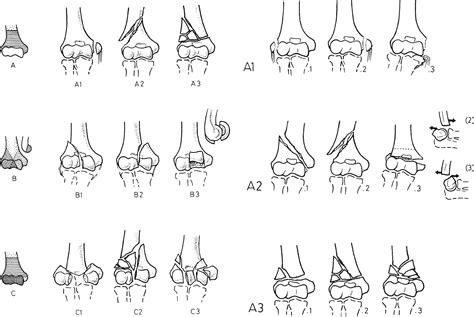 Classification Of Fractures Of The Distal Humerus A Ao Classification