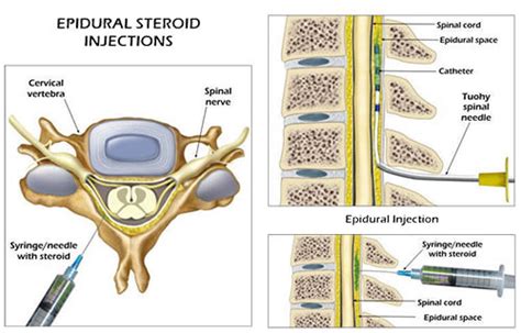 Caudal Epidural Steroid Injection Anatomy