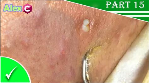 Your pore strips aren't actually doing much. How to removal nose blackheads and whiteheads yourself ...