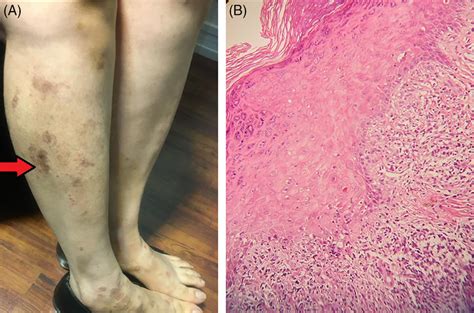 A Multiple Erythematous Papules And Plaques On The Extremities