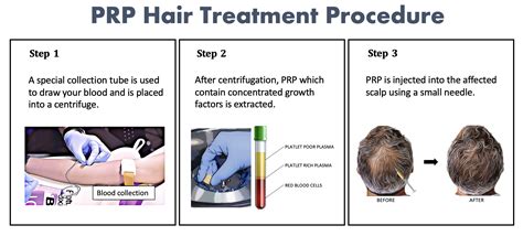 Prp Hair Loss Treatment Xeoul Clinic