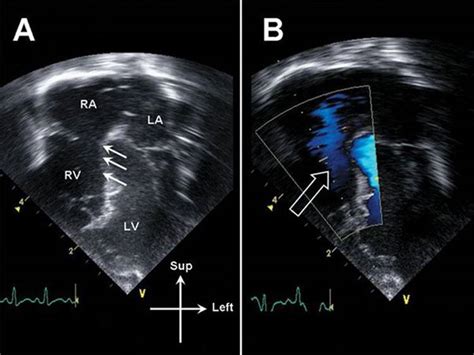 Abnormalities Of Right Ventricular Outflow Echocardiography In
