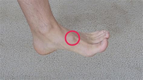 A common cause of bone spurs is osteoarthritis. Saddle Bone Deformity - Fix Flat Feet