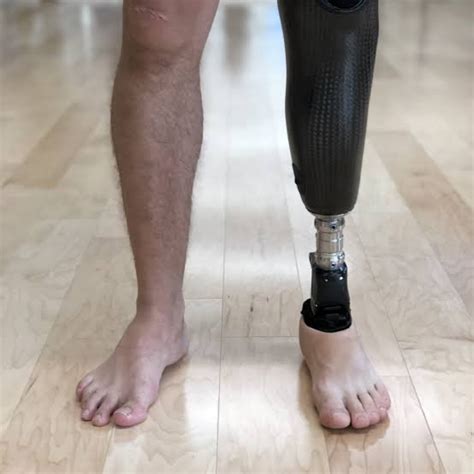 Artificial Below Knee Prosthesis Artificial Leg Kalyan Orthotics And