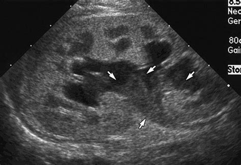 Us Of Renal Insufficiency In Neonates Radiographics