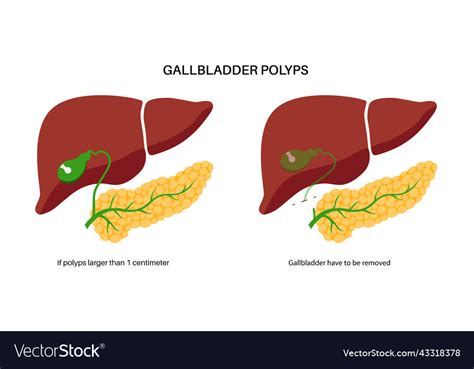 Gallbladder Anatomy Poster Royalty Free Vector Image