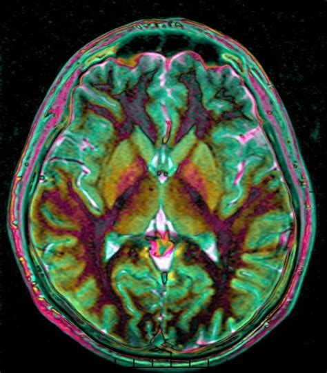 How Much Does Brain Mri Cost In 2024