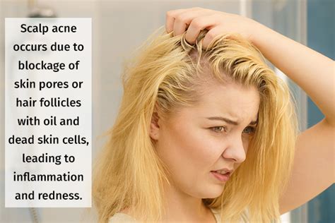 Scalp Folliculitis Natural Treatment