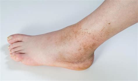 Cause Of Swollen Ankles In The Morning Causes Of Swelling In Lower